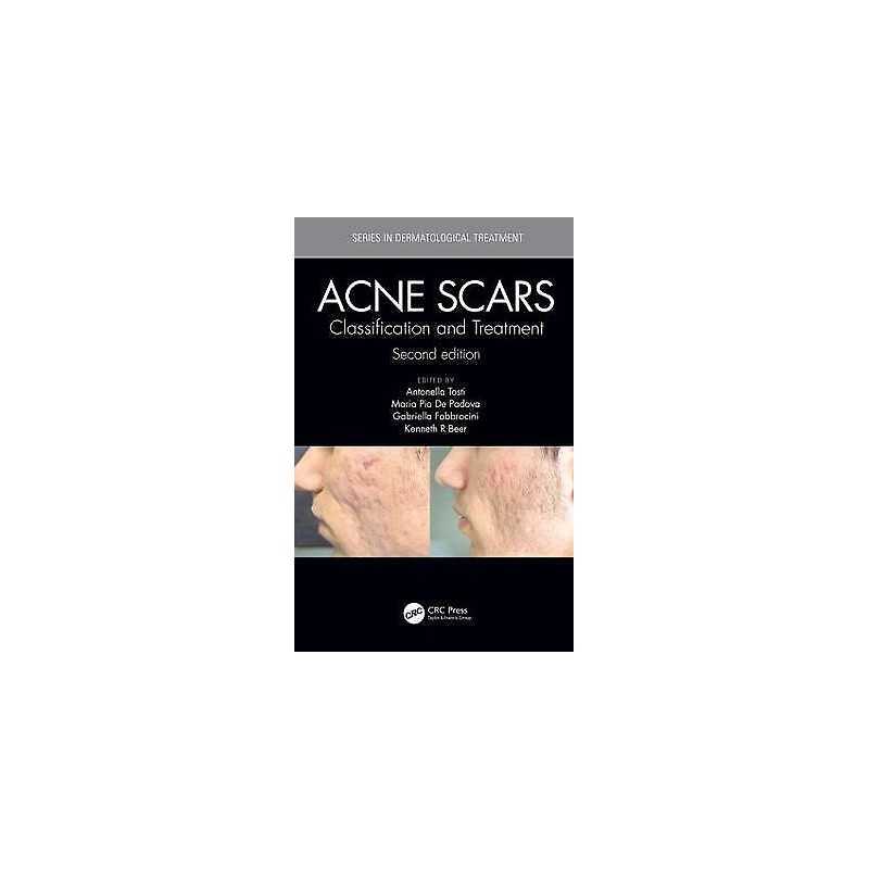 Acne Scars - 9781138894228