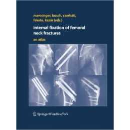 Internal fixation of femoral neck fractures - 9783709120026