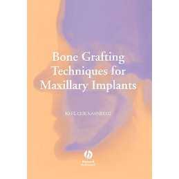 Bone Grafting Techniques for Maxillary Implants - 9781405129947